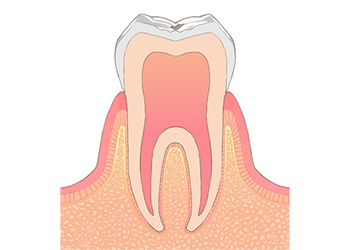 初期の虫歯