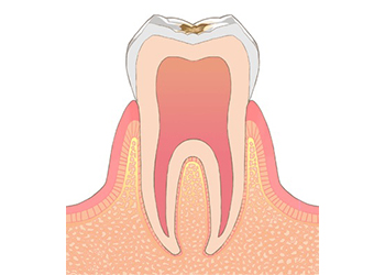 エナメル質内の虫歯