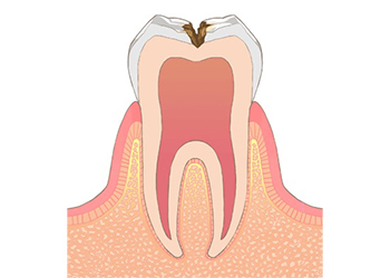 象牙質に達した虫歯