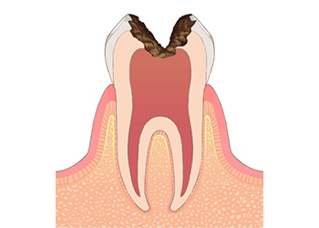 歯髄(神経)に達した虫歯
