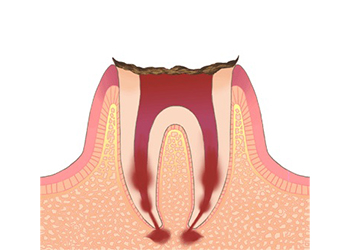 歯質が失われた虫歯