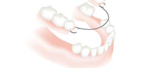 部分入れ歯