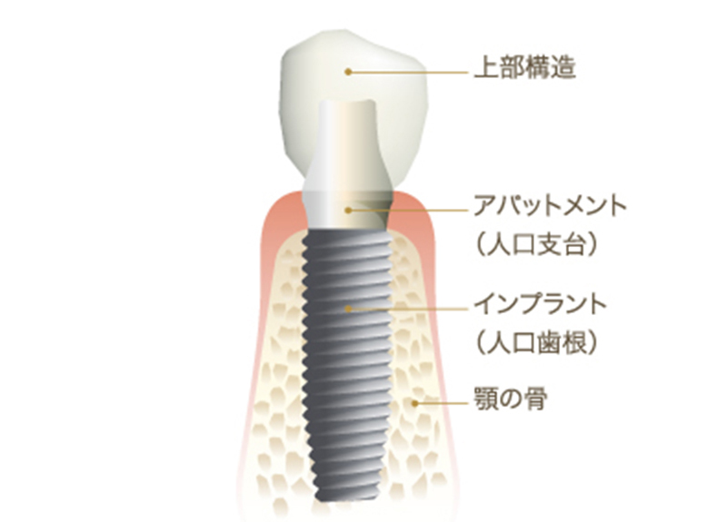 インプラントの構造