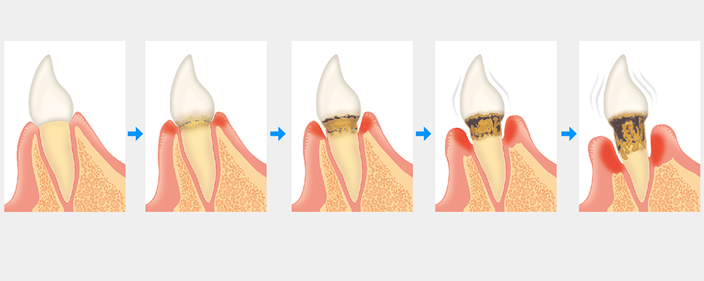 歯周病の原因とメカニズム